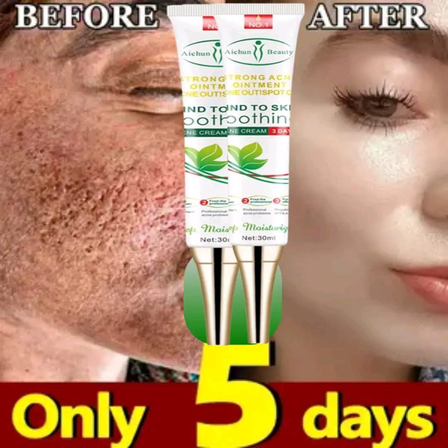 Aichun cream for acne Scars pimple removal for men and women